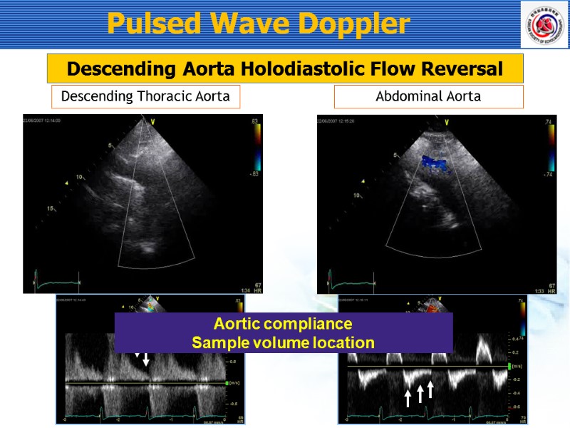 Pulsed Wave Doppler Descending Thoracic Aorta Abdominal Aorta Descending Aorta Holodiastolic Flow Reversal Aortic